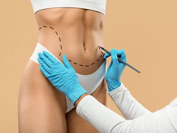 Abdominoplastia