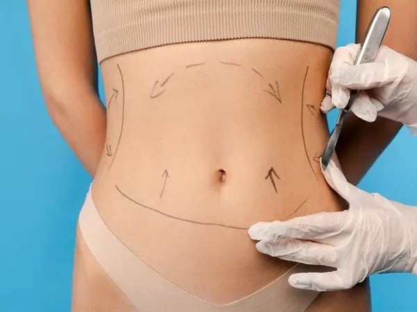 Lipoaspiração