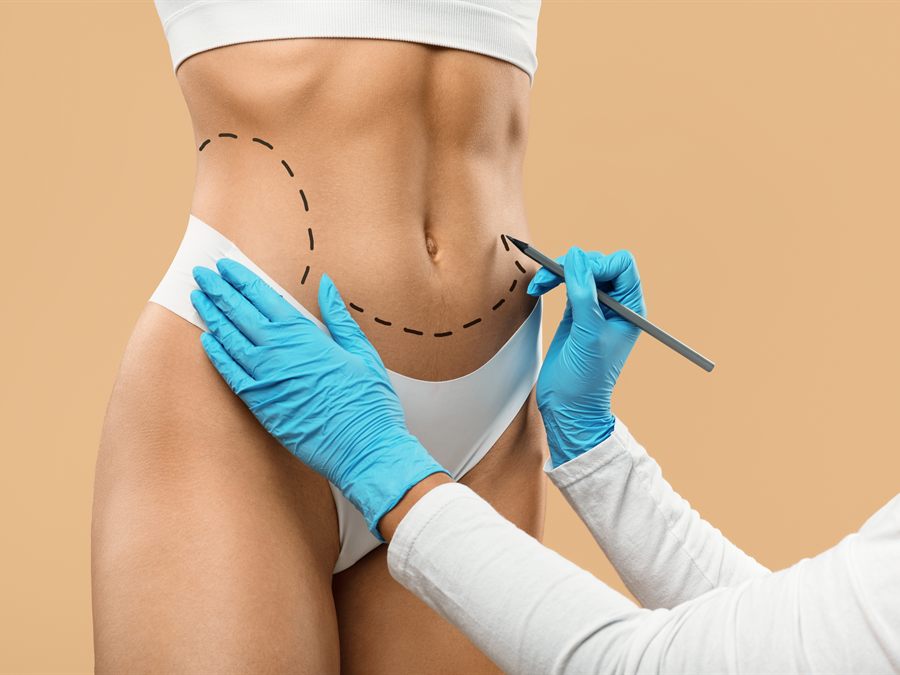 Abdominoplastia